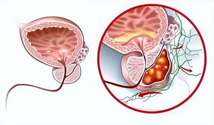 告诫男性：想要保护前列腺健康，日常远离这6件事是关键！